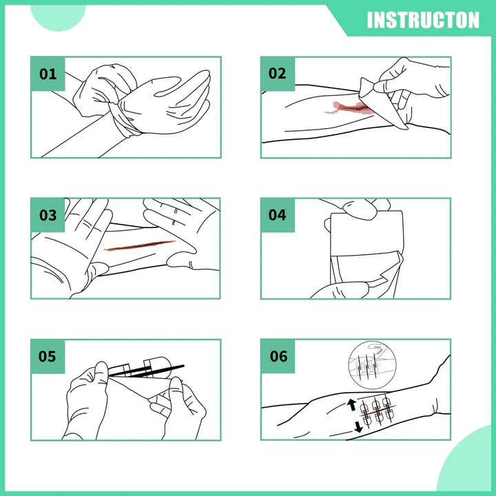 Wound Closure Kit